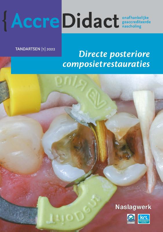 Directe posteriore composietrestauraties / AccreDidact / TA2022-1